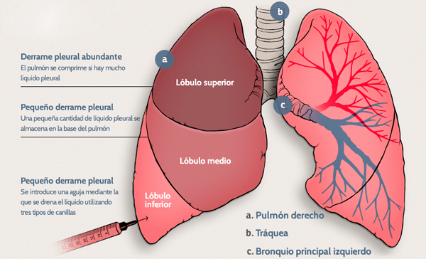 Derrame pleural en Monterrey