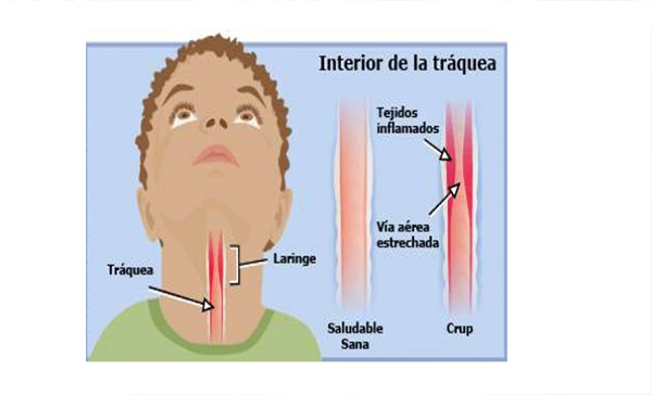 Laringotraqueobronquitis en Monterrey